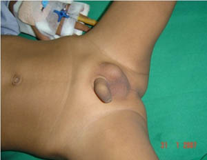 Undescended testis