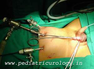 laparoscopic orchiopexy 