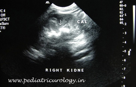 ultrasound for kidney stone