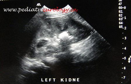 Test for kidney stone