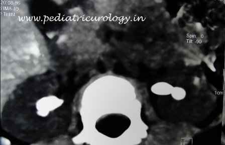 ultrasound for kidney stone