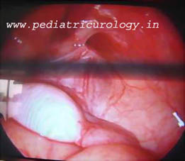 surgery for undescended testis