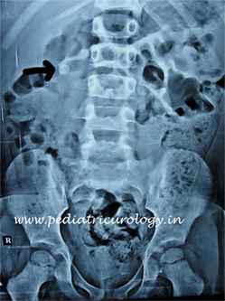 Kidney stone in a child