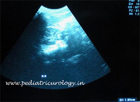 Lithotripsy for stone