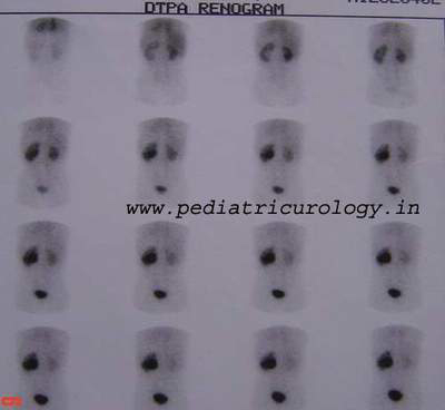 Renal scan showing PUJ Obstruction