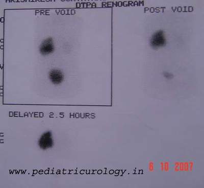 DTPA scan kidney swelling