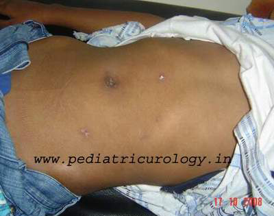 Laparoscopic pyeloplasty