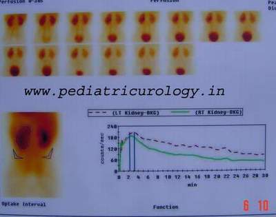 Renal scan