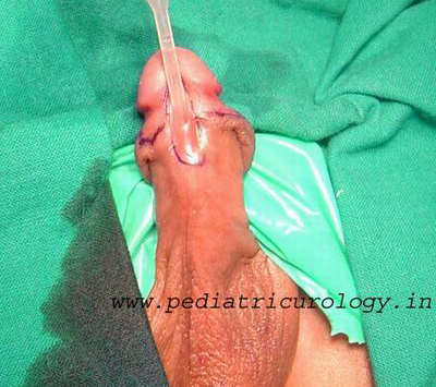 Distal penile hypospadias