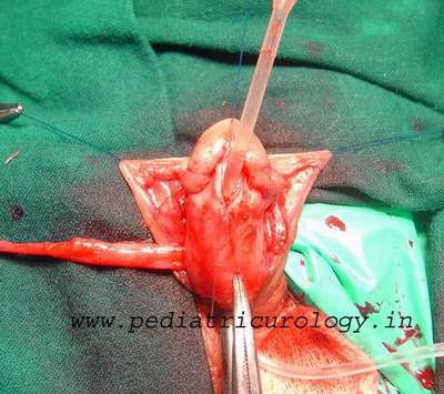 Hypospadias surgery