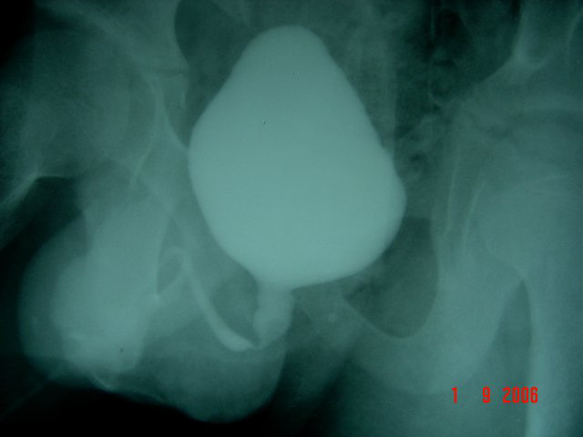 neuropathic bladder in a child