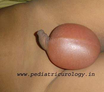 testis swelling in child