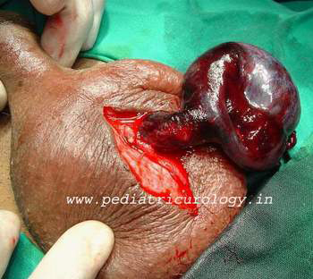 testicular torsion child