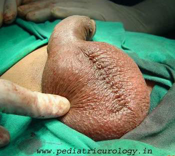 surgery for testis torsion