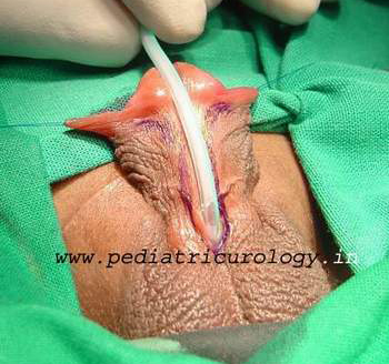 penoscrotal hypospadias