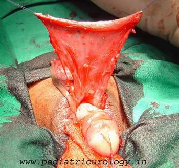 onlay island flap urethroplastt