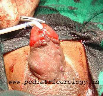 penoscrotal hypospadias repair completed