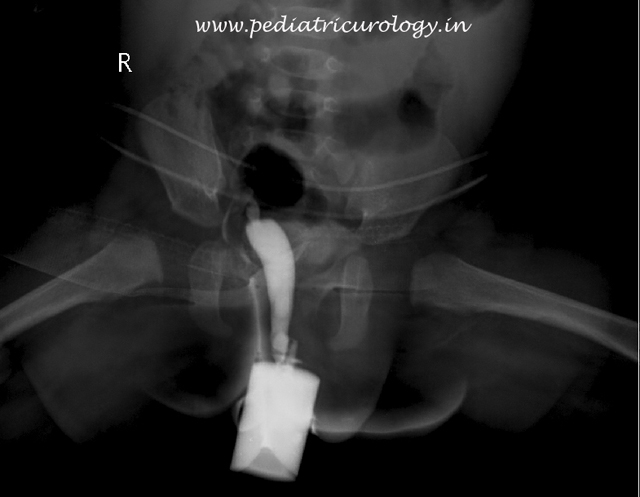 Single stage hypospadias repair
