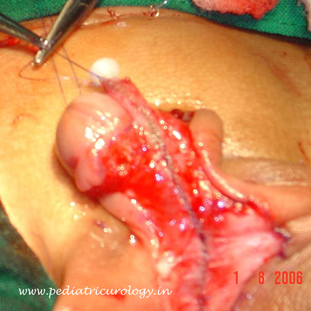 Hysterectomy specimen