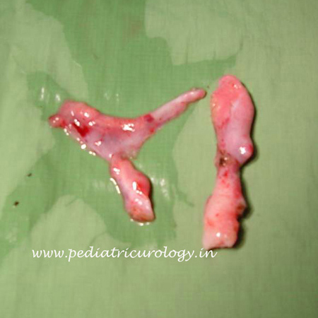 Hypospadias surgery outcome