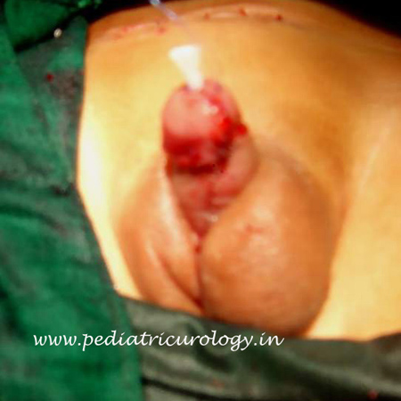 completed single Stage urethroplasty