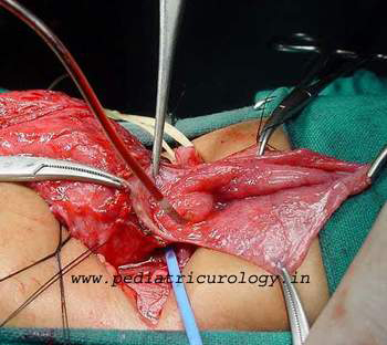 surgery picture of bladder diverticulum