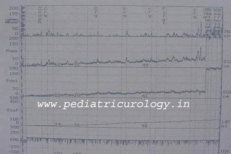 Urodynamic study in a child