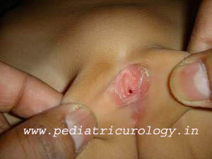 labial adhesions