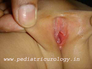 treatment of labial adhesions