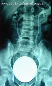 MCU showing VUR reflux in a child