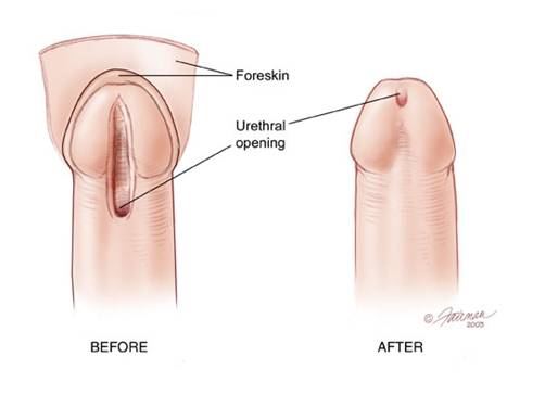 Hypospadias surgery 