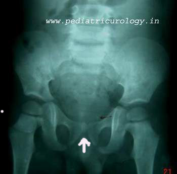 Xray urethral stone