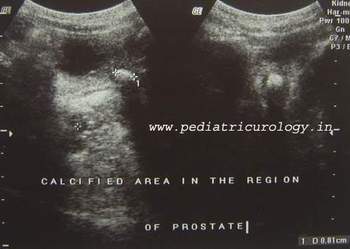 Ultrasound urethral stone