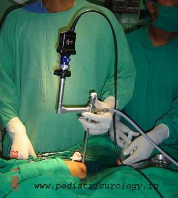 surgery for urethral stone