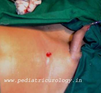 removal of urethral stone