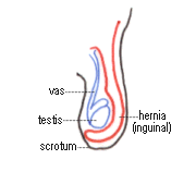 Inguinal hernia in a boy