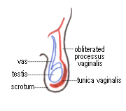 Hydrocele in a child