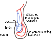 Hydrocele in a child