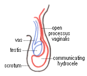 Hydrocele in a child