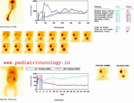 Renal scan showing PUJ Obstruction