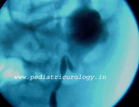 Normal Scan after pyeloplasty surgery