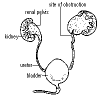 PUJ Obstruction in a child