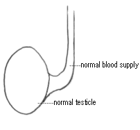 testis torsion
