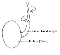 testis torsion